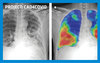 CAD4COVID - Delft Imaging Delft Imaging developed a CAD4COVID an AI based software that triages COVID-19 suspects on chest X-ray images and indicates the affected lung tissue for free of charge. READ MORE >> image-108